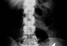 Как получают рентгеновские снимки и что они показывают?